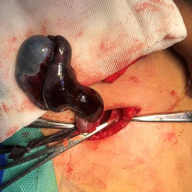 Diagnosis and treatment of cryptorchid testicular torsion in children: A 12-year retrospective study
